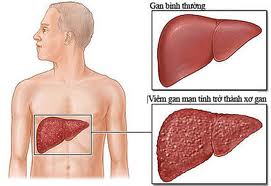 Cirrhosis - Hình ảnh minh họa